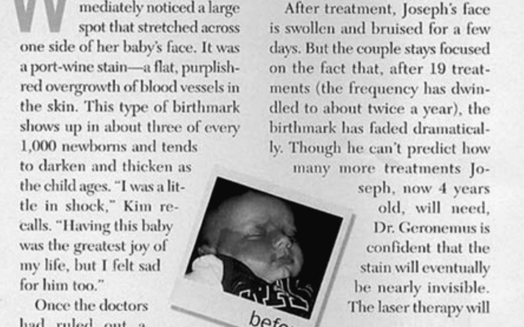 birthmark removal article in new york