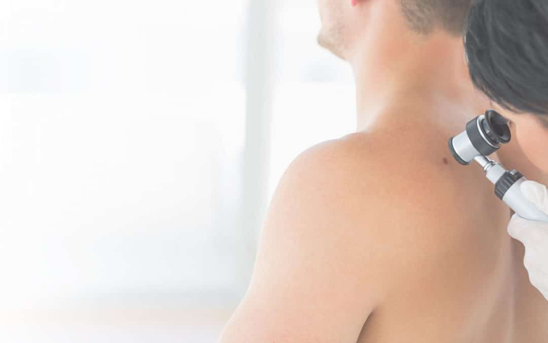 A man receiving a Mohs skin cancer check on her back at Millburn Laser Center located in Millburn New Jersey