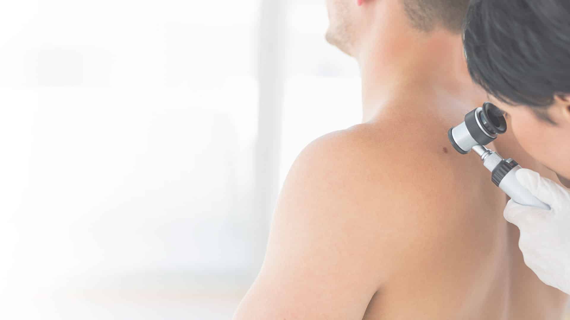 lsscny stock photo of doctor examining basal cell carcinoma new york, ny