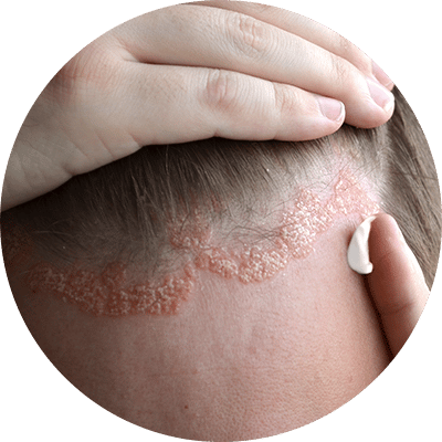 Psioriasis-Laser_Skin_New_york_City Image of a woman's scalp with psoriasis, NYC, NY