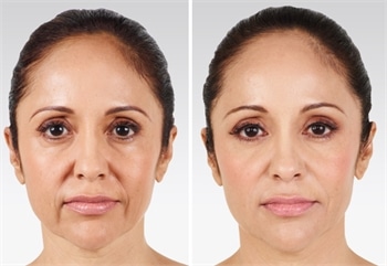 wrinkle smoother botox