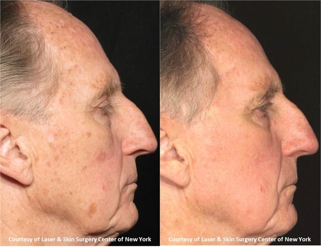 laser & skin surgery center of new york fractional resurfacing before and after new york city ny