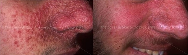 lsscny before and after photo of male patient with tuberous sclerosis near nose new york ny lsscny before and after photo of male patient with tuberous sclerosis near nose new york ny