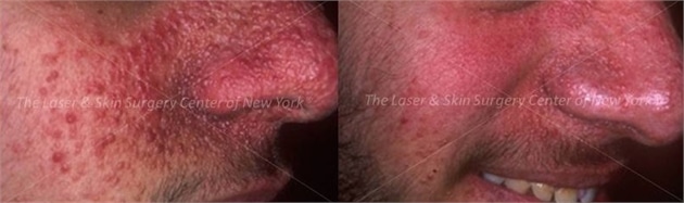 lsscny before and after photo of male patient with tuberous sclerosis near nose new york ny