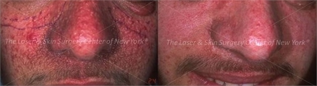 lsscny before and after photo of male patient with tuberous sclerosis new york ny lsscny before and after photo of male patient with tuberous sclerosis new york ny