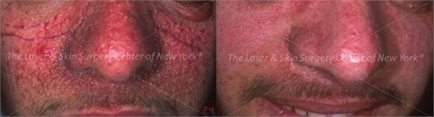 lsscny before and after photo of male patient with tuberous sclerosis new york ny