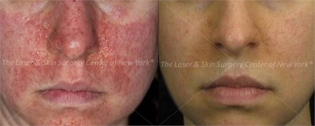 lsscny before and after photo of patient with tuberous sclerosis new york ny