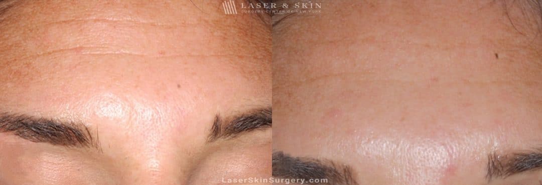 Before and after image of a botox injection procedure to a female patient's forehead to help relax her forehead wrinkles.