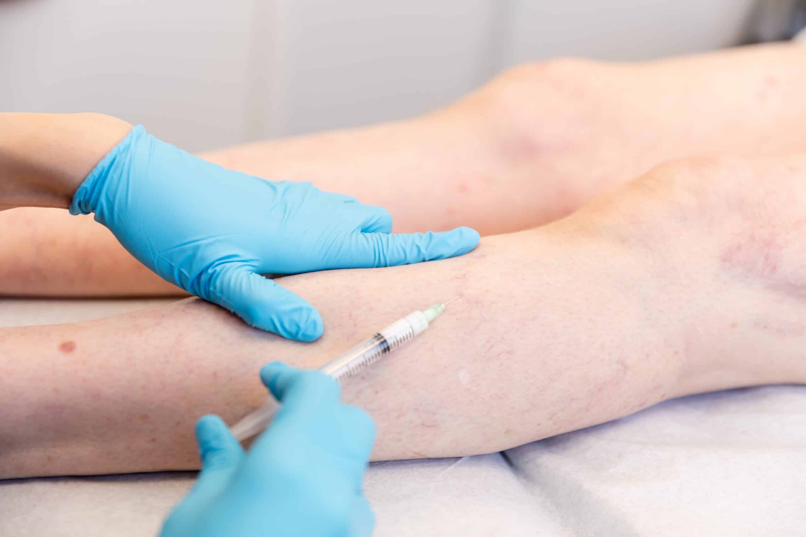 leg vein removal in  new york