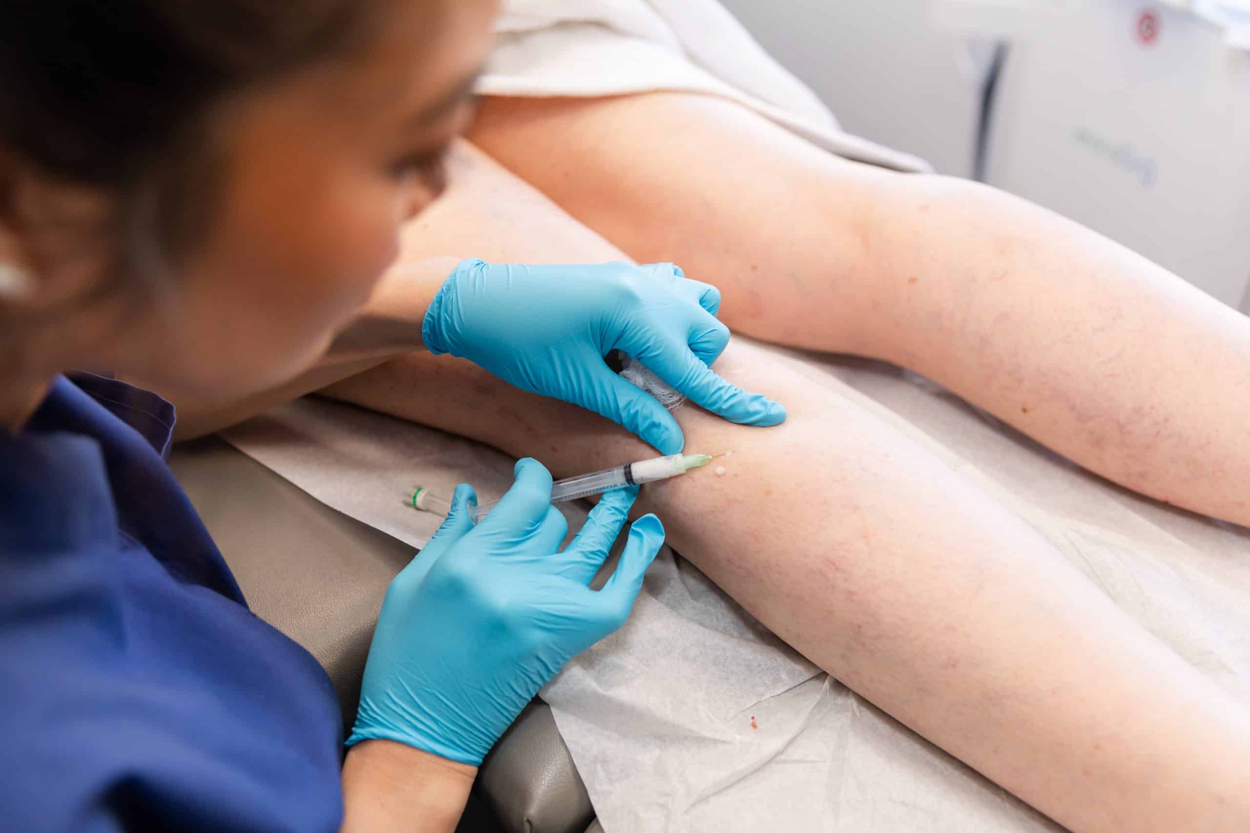 sclerotherapy procedure in new york