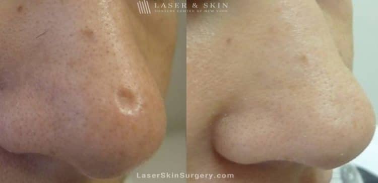 before and after image of a fraxel laser for scar removal on the nose