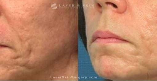 Fraxel Laser Treatment For Facial  Acne Scarring