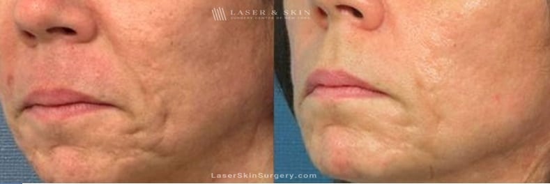 before and after image of a Fraxel Laser Treatment For Facial Acne Scarring