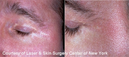 hypopigmentation treatment in new york