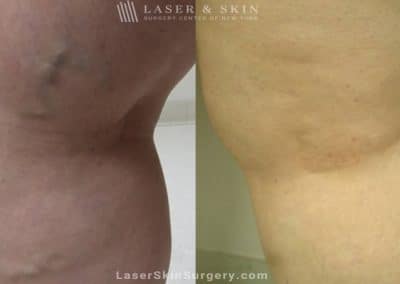 Sclerotherapy Injections for the Treatment of Leg Veins