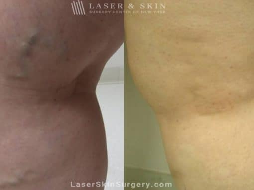 Sclerotherapy Injections for the Treatment of Leg Veins