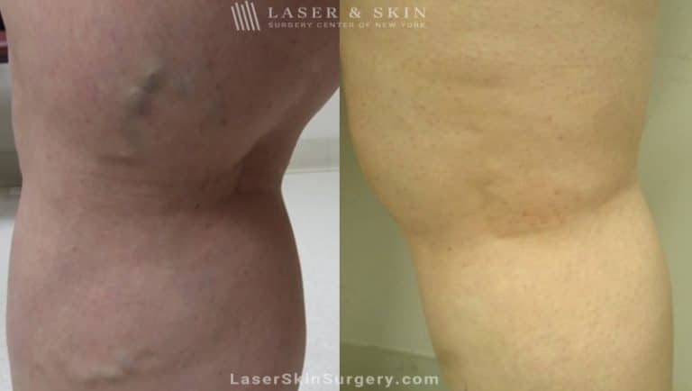 Sclerotherapy Injections for the Treatment of Leg Veins