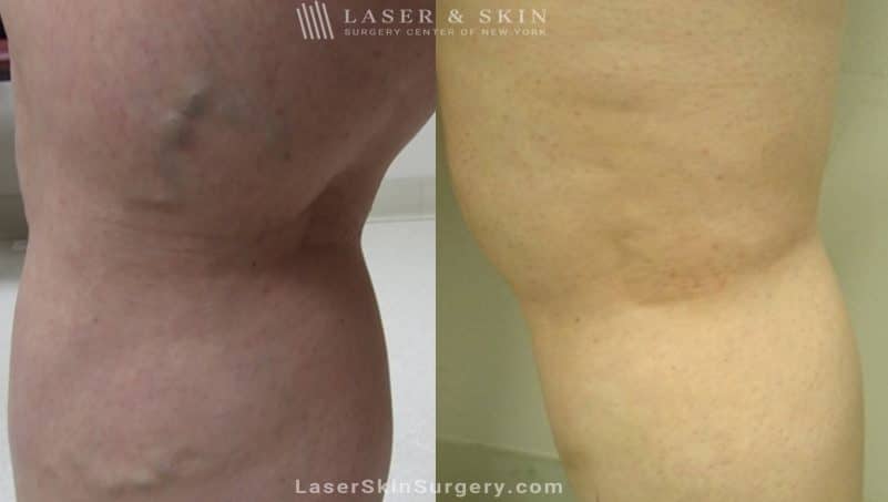 before and after image of a Sclerotherapy injections for the treatment of spider veins on the legs