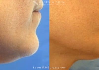 Kybella Injections for Double Chin Treatment