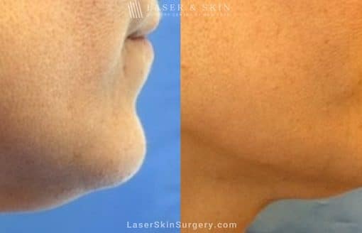 Kybella Injections for Double Chin Treatment