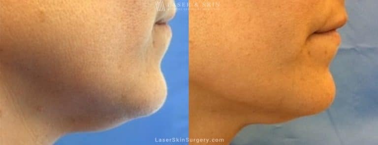 Kybella Injections for Double Chin Treatment