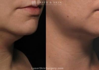 Kybella Injections for Double Chin Treatment