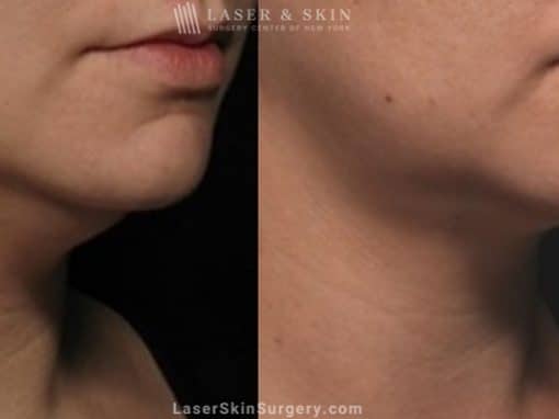 Kybella Injections for Double Chin Treatment