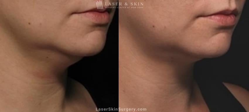 image of a before and after kybella injections to reduce the appearance of fat in the chin and neck