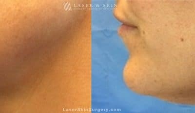 Kybella Injections for Double Chin Treatment