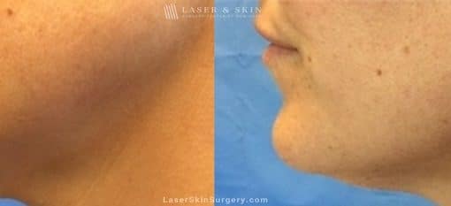 Kybella Injections for Double Chin Treatment