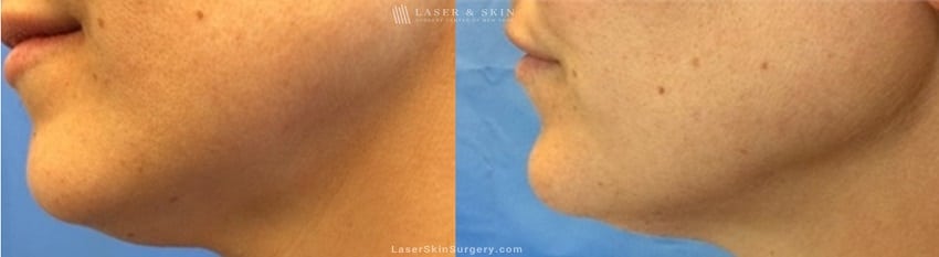 image of a before and after kybella injections to reduce the appearance of fat in the chin and neck