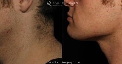 Kybella Injections for Double Chin Treatment