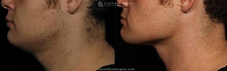 Kybella Injections for Double Chin Treatment