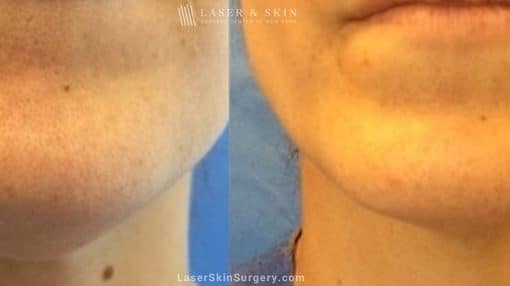 Kybella Injections for Double Chin Treatment