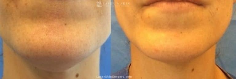 Kybella Injections for Double Chin Treatment