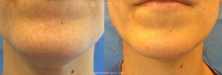 image of a before and after kybella injections to reduce the appearance of fat in the chin