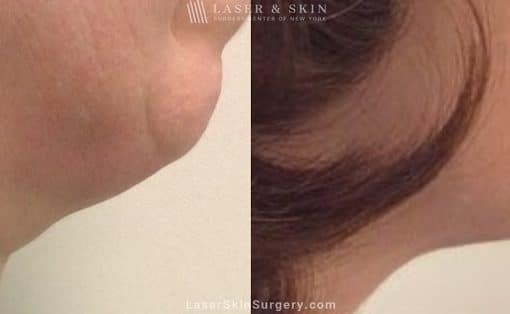 Kybella Injections for Double Chin Treatment