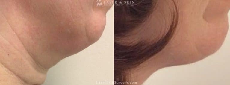 Kybella Injections for Double Chin Treatment