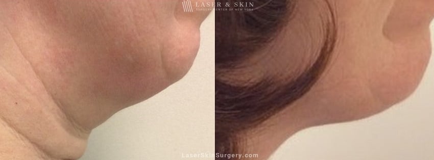 image of a before and after kybella injections to reduce the appearance of fat in the chin and neck