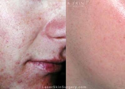 Laser to reduce appearance of acne scarring