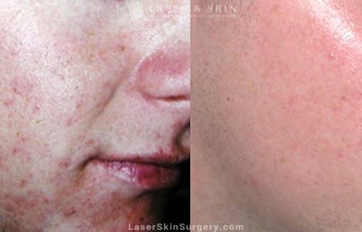 Laser to reduce appearance of acne scarring