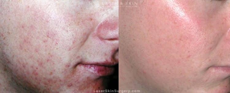 before and after image of a laser treatment for acne scars on a young mans face