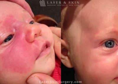 Laser Treatment for Birthmark Removal