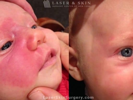 Laser Treatment for Birthmark Removal