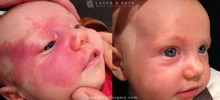 Laser Treatment for Birthmark Removal