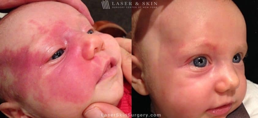 before and after image of a Laser Treatment for the removal of a facial birthmark on a baby