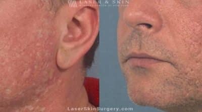 Laser Treatment to Remove Facial Acne Scarring