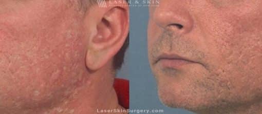 Laser Treatment to Remove Facial Acne Scarring