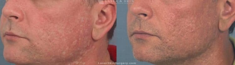 before and after image of a Laser treatment to remove facial acne scarring