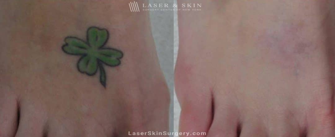 before and after image of a small green and black tattoo on the foot